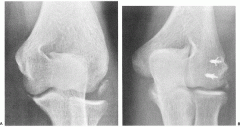was the most common motor failure of the LCL ligament with an elbow dislocation