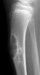 A 3-year-old boy was referred to you for evaluation of a bowing deformity of his leg and a persistent limp. Radiograph is shown. What is the most likely diagnosis?  
1.  Fibrous dysplasia
2.  Unicameral bone cyst
3.  Aneurysmal bone cyst
4.  O...