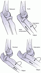 the LCL inserts on the supinator crest this into the lesser sigmoid notch
They resist varus and posterior laterally rotary instability 
the lateral ulnar collateral ligament