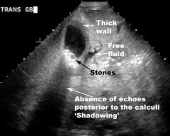 1. RUQ ultrasound is the test of choice- high sensitivity and specificity. Findings include thickened gallbladder wall and pericholecystic fluid, distended gallbladder, and presence of stone(s)
2. CT scan is as accurate as ultrasound but is more ...