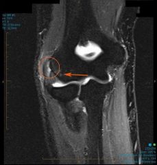 tennis elbow = inflammation of the ECR B= angiofibroma last hyperplasia
, disorganized collagen MRI– increased signal intensity at the ECRB tendon
Steroid injections ×3
release and debridement of the ECRB origin after 9-12 months of failed cons...