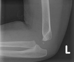 A 2-year-old is brought to the emergency room with reports of elbow pain and limited use of the left upper extremity. The patient is neurovascularly intact, but examination is limited secondary to pain. AP and lateral radiographs are shown in Figu...