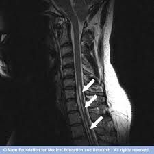 syringomyeliaa fluid-filled cavity within the spinal cord that expands progressively at least an neurologic deficits
a syrinx  within the brainstem and leads to neurologic symptoms– tong weakness and atrophy – cranial nerve XII: Sternocleidom...