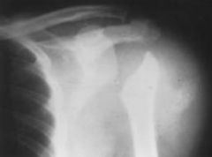 patient presents with painless loss of function of the shoulder exam reveals warm swollen erythematous joint


What is the diagnosis
with the next best diagnostic study to confirm the diagnosis
Was a treatment
What test is helpful to rule out in...