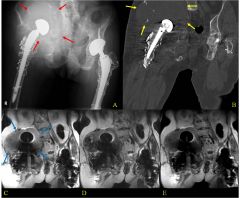 sciatic nerve palsy
CT scan – rule out hematoma, EMG – guide patient regarding discussion
differential diagnoses – hematoma, retraction, type bandages, direct,, deep from PMMA, unknown 40%
Initially placed hip in extension and flex the knee ...