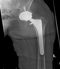 A 62-year-old female has persistent activity related anterior groin pain 10 months after total hip arthroplasty (THA). Infection workup is negative. New radiographs are unchanged compared to the intial films provided in Figures A and B. Pain is te...