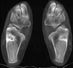 patient presents with limited subtalar motion hindfoot valgus and recurrent ankle sprains


with the diagnosis
what image confirmed the diagnosis
What is the treatment