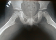 A 9-year-old male is brought in for initial evaluation of persistent painless limping favoring the left leg. His symptoms began 6 months ago, and have been progressively worsening. He has nearly full abduction. Radiographs and an MRI are shown in ...