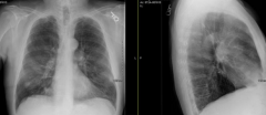 Case 1:
- What do you notice about his chest x-ray?