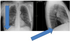 - AP diameter is enlarged (hyperinflation)
- More air retrosternally than expected
- Flat diaphragm
- Decreased lung markings