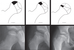 For children with Legg-Calve-Perthes(LCP) disease, all of the following factors are associated with femoral head incongruity and worse clinical outcome EXCEPT:  
1.  Maintenance of less than 50% of lateral pillar height
2.  Presentation at 5 yea...