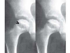 LCP is a disease of children in which the vascular supply to the femoral head is compromised leading to avascular necrosis of the femoral head and can subsequently result in resorption, collapse and repair. Children who present at an age < 6 years...
