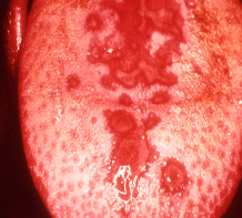 Symptoms of Scarlet fever? What is etiology?