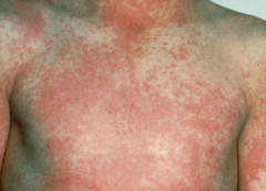 Describe pattern of rash in scarlet fever