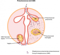 Routes of entry and disease of Pneumococcus & GBS?