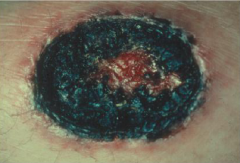 Bacteremia may lead to papules that progress to black necrotic ulcres due to the direct invasion of vessels.

Result from environmental contamination, leads to necrotic lesions that may lead to bacteremia.