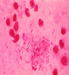 Gram smear of pus from an abdominal abscess showing polymorphonuclear leukocytes, large numbers of Gram-negative anaerobes, and some peptostreptococci.