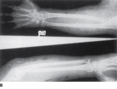 Arm of a drug abuser with ulcers and swelling traced to needle tracks. B. Radiographs from the same patient demonstrating gas (clear spaces) in the tissues.