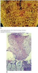 Clostridium difficile pseudomembranous colitis. A. Colon with discrete plaques of pseudomembrane. B. Histopathology demonstrates the pseudomembrane above the mucosa. It is "pseudo" because it is composed of only fibrin and inflammatory cells.
