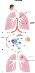 Tuberculosis. A. Primary tuberculosis. Mucobacterium tuberculosis is inhaled in droplet nuclei from an active case of tuberculosis. Initial multiplication is in the alveoli with spread through lymphatic drainage to the hilar lymph nodes. After further lym