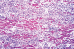 Diphtheritic myocarditis. Necrosis and inflammation are present in this section of myocardium from a fatal case of diphtheria.