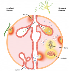 ----------------------
Fungi system view. Localized disease (left) is produced by local trauma or the superficial invasion of flora resident on the oropharyngeal (thrush), gastrointestinal, or vaginal mucosa. Systemic disease (right) begins with inhalati