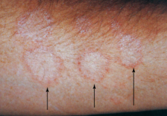slowly progressive eruptions of the skin & appendages 
unsightly, not painful or life threatening. 
manifestations vary, depending on inflammatory response  
typically involve erythema, induration, itching, and scaling.