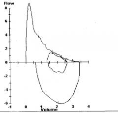 What does this spirometry show? If this was the patient in case 2's spirometry, what diagnosis would you suspect?