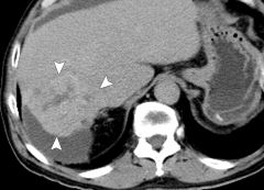 1. tumor of the intrahepatic and extrahepatic bile ducts: most are adenocarcinomas
2. mean age of diagnosis is in the 7th decade
3. Located in three regions: proximal third of the CBD (most common, also called Klatskin's tumor), distal extrahepa...