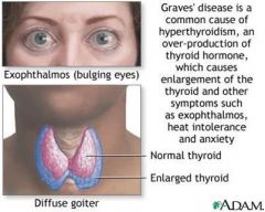 drugs to block thyroxine
Radiation to destroy the gland
Subtotal thyroidectomy