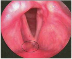 Hoarseness, stridor, globus and dysphagus

Diagnosis is based on laryngeal examination showing waxy lesions that may be gray or orange, typically on the epiglottis, but sometimes glottic or subglottic.
