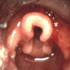Laryngomalacia - supraglottis is flaccid, and epiglottis or interarytenoid tissue collapse during inspiration to obstruct the airway