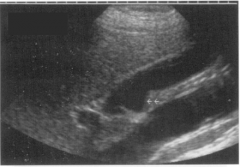 This gallbladder is demonstrating which variant?