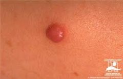  
smooth pink to brown to jet black dome-shaped papule that usually enlarges rapidly after it appearsthese are generally benign, although they may need to be excised if there is rapid growth because rarely malignant forms do occur