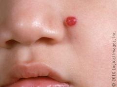  
vascular tumors which are common in infancy
occur in 1-2% of neonates
more common in females, caucasians, and premature infants
classified as superficial, deep, or mixedgenerally not present at birth
can be found in any location, but are most c...