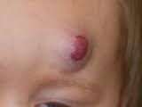 Superficial hemagiomas are bright red and non-compressible, whereas deep hemangiomas are subcutaneous, compressible and often have a bluish hue and superficial telangiectasias
* Image shows deep infantile hemangioma
 