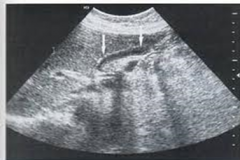 Does this image show a contracted or uncontracted gallbladder?