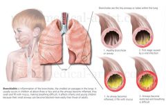 Bronchiolitis is defined as the FIRST episode of wheezing associated with urti and signs of respiratory distress. It is inflammation of the bronchioles, the smallest air passages of the lungs. It usually occurs in children less than two years of a...