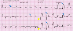 - ST-segment elevation (d/t complete occlusion of vessel) = blue arrows
- Pathologic Q wave formation in leads overlying infarcted area  = yellow arrows