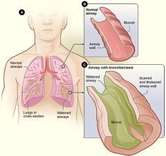 Bronchiectasis is a disease state defined by localized, irreversible dilation of part of the bronchial tree caused by destruction of the muscle and elastic tissue. It is classified as an obstructive lung disease, along with emphysema, bronchitis, ...