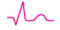 EKG - look for significant Q wave (deep and wide) - indicates permanent tissue death