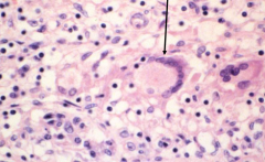 Giant cells may contain up to 200 nuclei due to fusion of macropahges. Their function is unknown, though they are thought to be more efficient than macrophages at clearing infection.