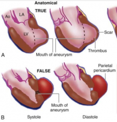 - True: mouth of aneurysm is wide / part of LV (covered by wall of ventricle)
- False: mouth of aneurysm is narrow and through wall of LV (only covered by parietal pericardium)