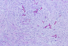 What causes this


Outline the pathogenesis of this disease
