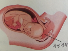 출산과정 중 자궁경부가 태아의 머리가 통과할 수 있는 정도 (10cm~12cm) 까지 열리는 기간은?