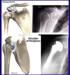 osteoarthritis- wear and tear
lose articular cartilage and then secondary change in the bone
thickens up and beoce osteophites 
