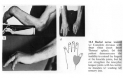 radial nerve (C5-T1) 
extensor muscles of arm and forearm 