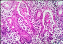 What is this characteristic finding in ulcerative colitis? What are they filled with?