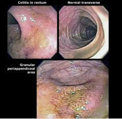 What percent of patients have rectal sparing? What is this called? If the rectum is normal, what is the disease? 
Does Crohn's disease typically have skip areas?