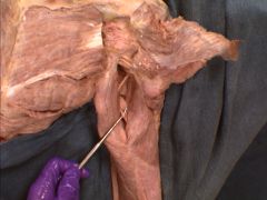 Shown here is the profunda brachii artery. It runs with what nerve?